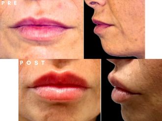 Filler labbra prima e dopo - 877794