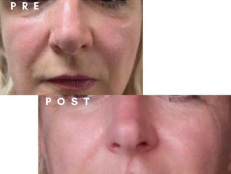 Filler prima e dopo - 877795