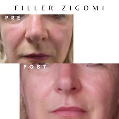 Dott. Giovanni Migliorini Filler Zigomi