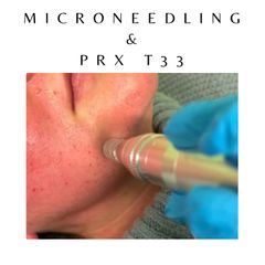 Dott. Giovanni Migliorini Microneedling & PRX T33