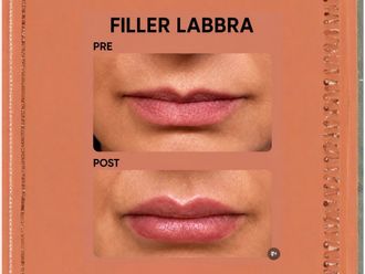 Filler labbra prima e dopo - 881021