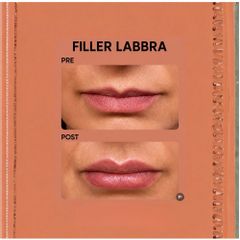 Dott. Giovanni Migliorini Filler labbra supernaturale
