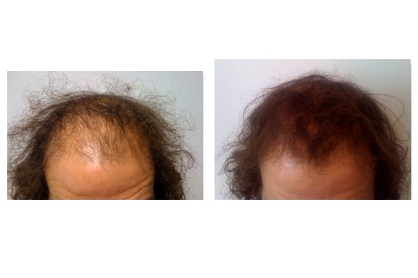 Alopecia prima e dopo - 744996