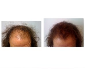alopecia prima dopo