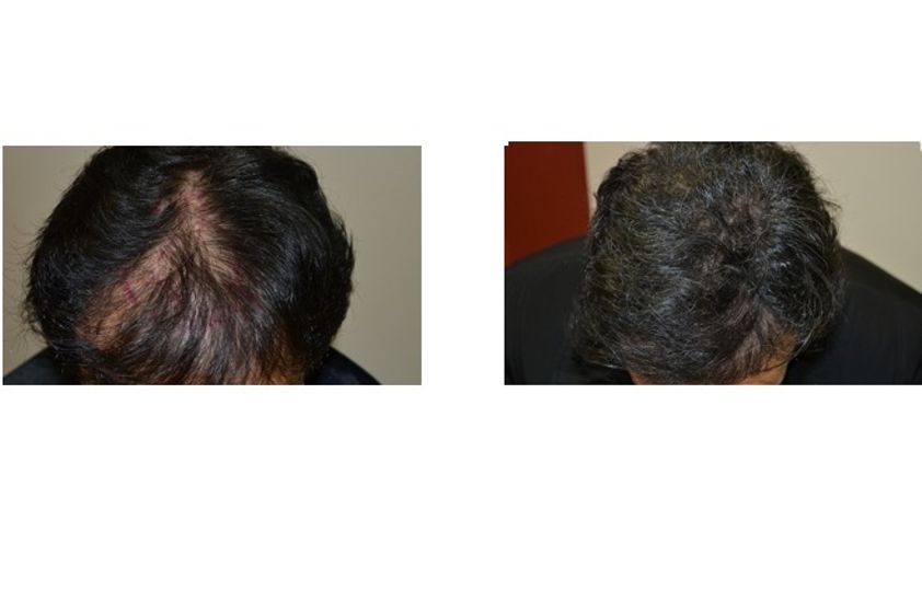 Trapianto capelli prima e dopo - 744998