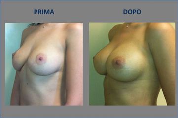 Mastoplastica additiva prima e dopo