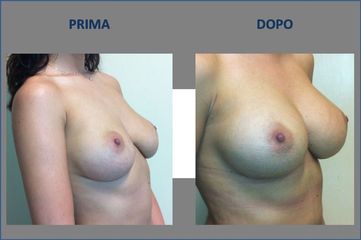 Mastoplastica additiva prima e dopo