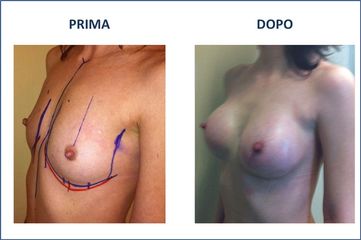 Mastoplastica additiva prima e dopo