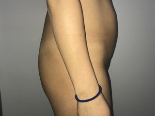 lipofilling gluteo pre