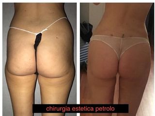 Liposcultura prima e dopo