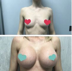 Mastoplastica additiva prima e dopo
