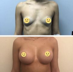 Mastoplastica additiva prima e dopo