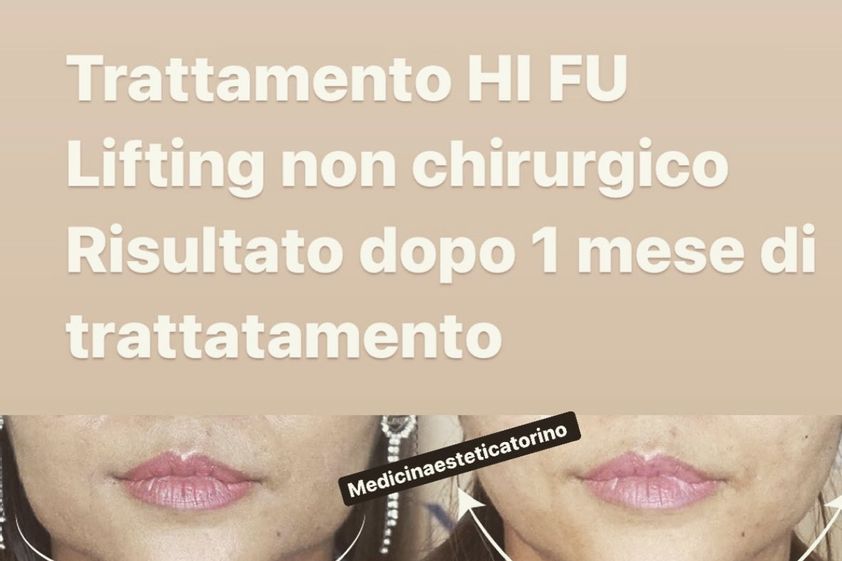 HIFU prima e dopo - 789863