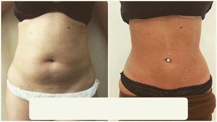 Liposuzione - Dr Benoit Menye
