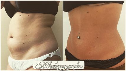 Liposuzione - Dr Benoit Menye
