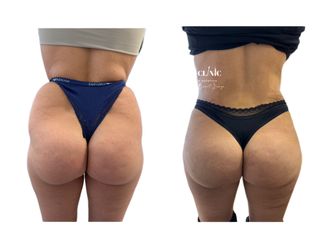 Gluteoplastica prima e dopo - 866791