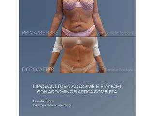 Addominoplastica - Dott. Daniele Bordoni