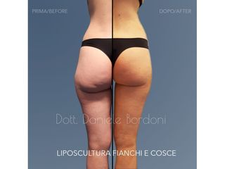 Liposcultura - Dott. Daniele Bordoni