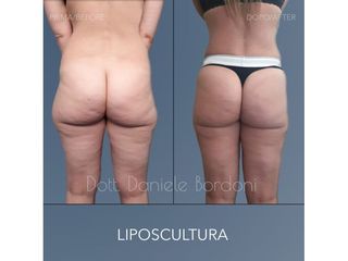 Liposcultura - Dott. Daniele Bordoni