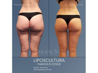 Liposcultura - Dott. Daniele Bordoni