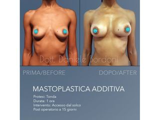Mastoplastica additiva - Dott. Daniele Bordoni