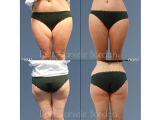 Liposcultura - Dott. Daniele Bordoni