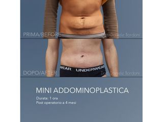 Addominoplastica - Dott. Daniele Bordoni