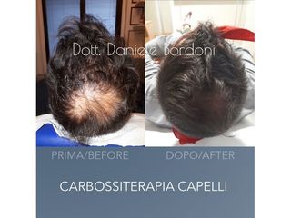 Carbossiterapia prima e dopo