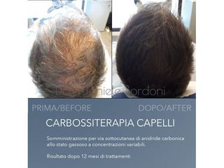 Carbossiterapia - Dott. Daniele Bordoni