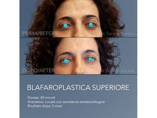 Blefaroplastica - Dott. Daniele Bordoni
