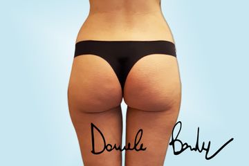 Liposcultura - Dott. Daniele Bordoni