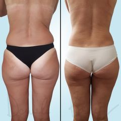 Liposcultura - Dott. Daniele Bordoni