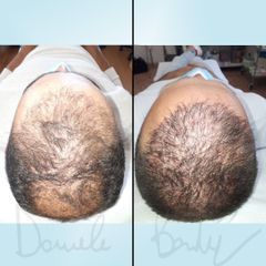Trapianto capelli - Dott. Daniele Bordoni
