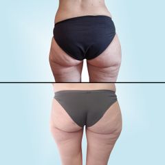 Liposuzione - Dott. Daniele Bordoni