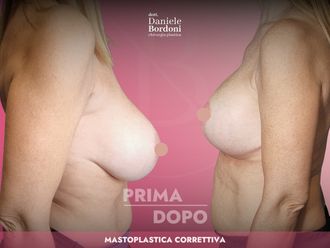 Mastopessi prima e dopo - 871672