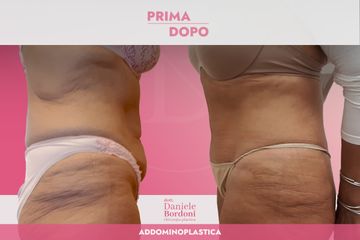 Addominoplastica Dott. Daniele Bordoni