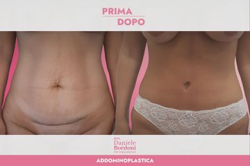 Addominoplastica Dott. Daniele Bordoni