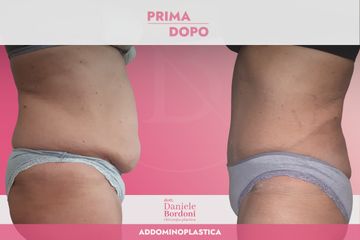 Addominoplastica Dott. Daniele Bordoni