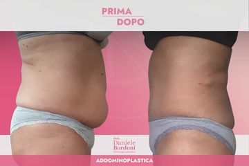 Addominoplastica Dott. Daniele Bordoni
