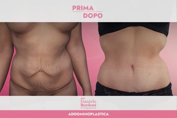 Addominoplastica Dott. Daniele Bordoni