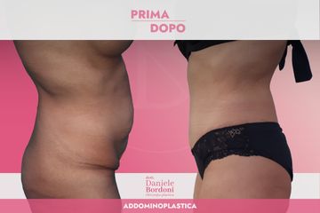 Addominoplastica Dott. Daniele Bordoni