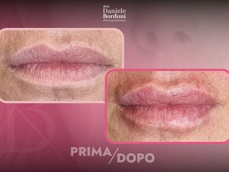 Filler labbra prima e dopo - 874819