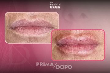 Dott. Daniele Bordoni Filler Labbra