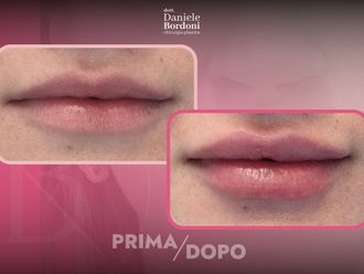 Filler labbra prima e dopo - 874820