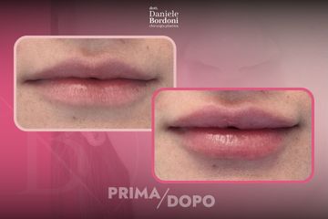 Dott. Daniele Bordoni Filler Labbra