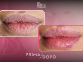 Filler labbra prima e dopo - 874821