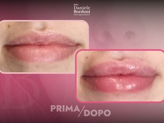 Filler labbra prima e dopo - 874822