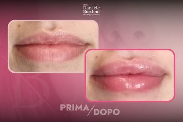 Dott. Daniele Bordoni Filler Labbra