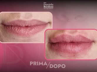 Filler labbra prima e dopo - 874823