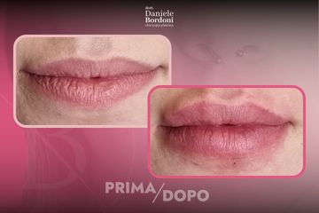 Dott. Daniele Bordoni Filler Labbra